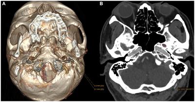 Association of concomitant continuous pain in trigeminal neuralgia with a narrow foramen ovale